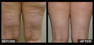 Velashape Before and After Legs